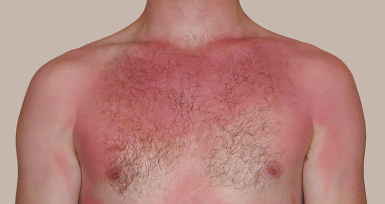 En man som blivit solbränd och därmed röd över hela kroppen. Någonting som kallas för första stadiets brännskada.